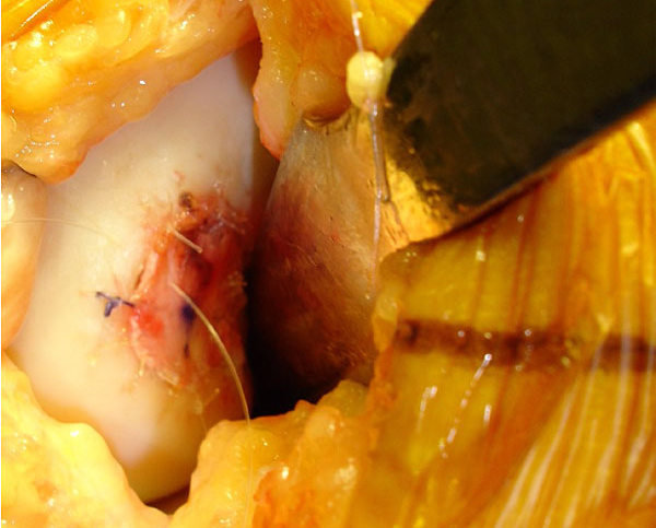 image of TACL reconstruction performed by Mr. Aslam Mohammed with a four strand hamstring  knee sports injuries consultant Mr Aslam Mohammed 25 years experience in treating meniscal tears in high level atheltics   knee injuries